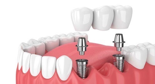 [!] Quy Trình Cấy Ghép Răng Implant Đúng Tiêu Chuẩn?;